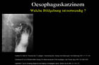 &Ouml;sophaguskarzinom
