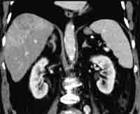 Präinterventionelles CT coronar in der portalvenösen Phase