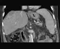 14 Mon. post PEIT: Tumornekrose in der CT coronar in der portalvenösen Phase