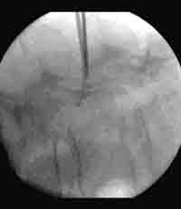 Durchleuchtungsgesteuerte Intervention am Processus articularis inferior von LWK 3 links