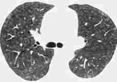 Exogen allergische Alveolitis /Hypersensitive Pneumonitis