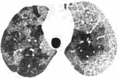 Alveolre Proteinose