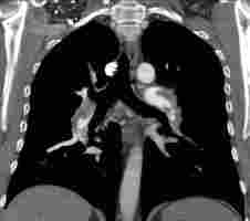 bilaterale interpulmonale sattelförmige Lungenarterienembolie mit subtotaler Verlegung der Unterlappenarterien beidseits