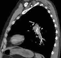 bilaterale interpulmonale sattelförmige Lungenarterienembolie mit subtotaler Verlegung der Unterlappenarterien beidseits