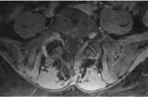 aktivierte Arthrose des Facettengelenkes L5/S1 rechts)