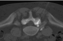 Therapie der aktivierten Facettengelenkarthrose mit Beimischung von Kontrastmittel zur Visualisierung der Synovialiszysten