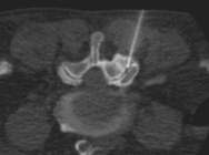 CT-Punktion eines deformierten Facettengelenkes im Segment L3/4 rechts