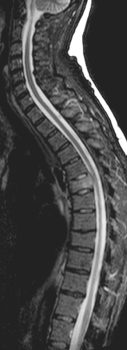 T2-gewichtete MRT der HWS/BWS mit
Darstellung einer Fraktur der Wirbelkrperdeckplatte von BWK 6 und einer Dorsalverlagerung der Wirbelkrperhinterkante in den
Spinalkanal 