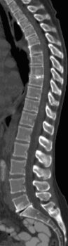 Sagittale Rekonstruktion einer Wirbelsulen-CT mit Nachweis einer Osteolyse von BWK 6 mit Destruktionen der
Wirbelkrperdeckplatte und der WK-Hinterkante