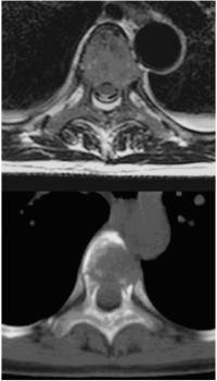  Transversale Schicht durch BWK 6 in einer T2-gew. Gradientenechosequenz und
in der CT mit Abbildung des die Wirbelkrperhinterkante penetrierenden Tumors und der pathologischen Frakturen der Bogenwurzeln
