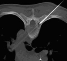 Transartikulrer Zugang zur Wirbelkrper-Osteolyse von rechts