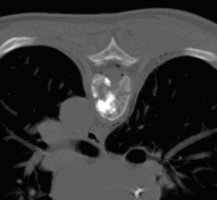 Zufriedenstellende Zementverteilung in der Osteolyse ohne weitere Dislokation von Wirbelkrperfragmenten in den Spinalkanal