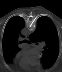 CT-gesteuerte transartikulre Vertebroplastie mit gnstiger Zementverteilung im gebrochenen Wirbelkrper