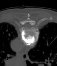 CT-gesteuerte transartikulre Vertebroplastie mit gnstiger Zementverteilung im gebrochenen Wirbelkrper