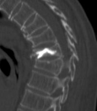  sagittale CT-Rekonstrukion nach Vertebroplastie 