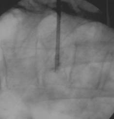 Parallele Durchleuchtung der Zielregion whrend der Vertebroplastie mittels C-Bogen am CT zur gesteuerten Zementeinbringung in den Wirbelkrper unter Real-Time-Bedinungen 