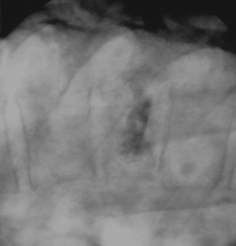 Parallele Durchleuchtung der Zielregion whrend der Vertebroplastie mittels C-Bogen am CT zur gesteuerten Zementeinbringung in den Wirbelkrper unter Real-Time-Bedinungen