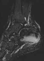 Calcaneopathia rheumatica 