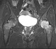 Transiente Osteoporose li. Hüftgelenk