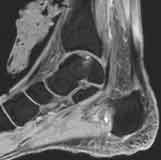 Osteochondrosis dissecans mediale Talusschulter