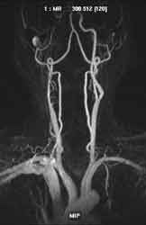 Arteria carotis interna-Verschluss re 