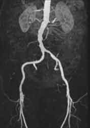 Nierenarterienstenose links